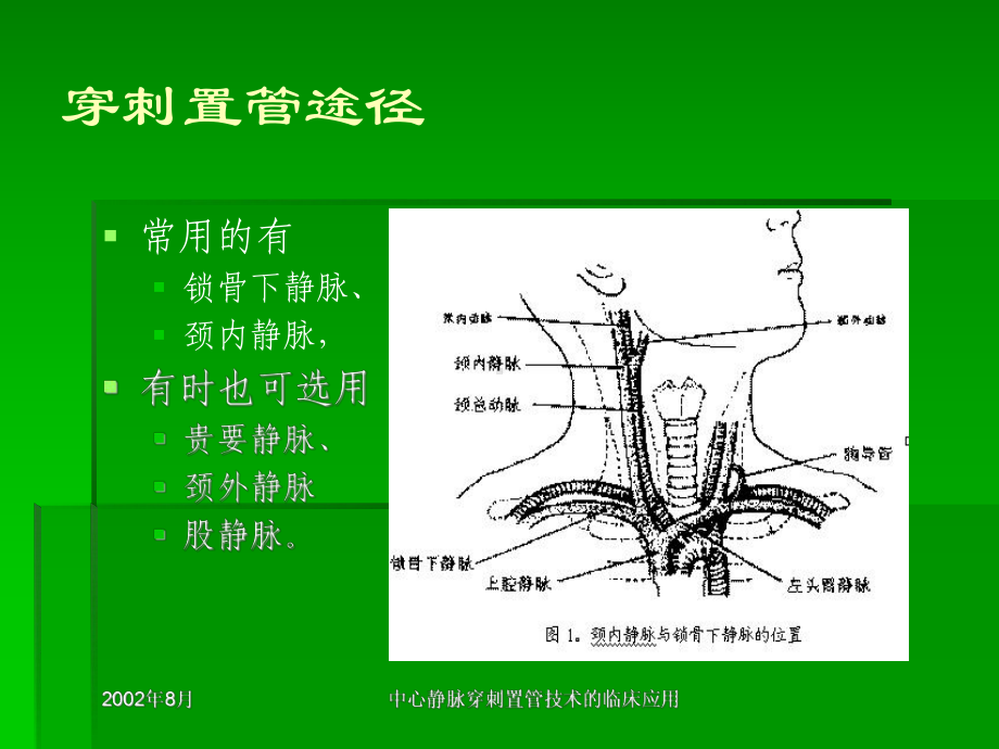 中间静脉穿刺置管技巧的临床应用课件.ppt_第3页