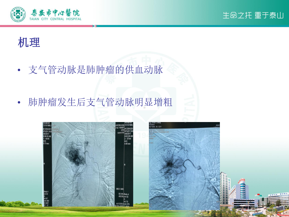 肺癌支气管动脉化疗栓塞术教学查房课件讲义.ppt_第3页