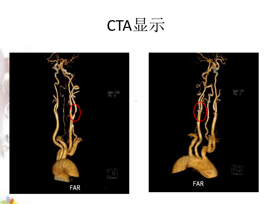 颈动脉狭窄课件.pptx_第3页