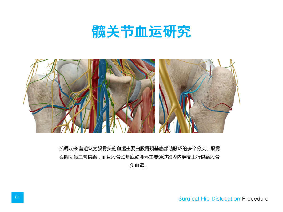 髋关节外科脱位汇编课件.ppt_第3页