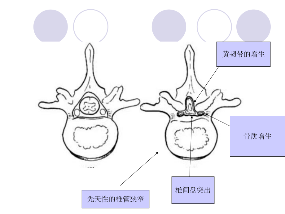 《腰椎管狭窄症》课件.ppt_第3页