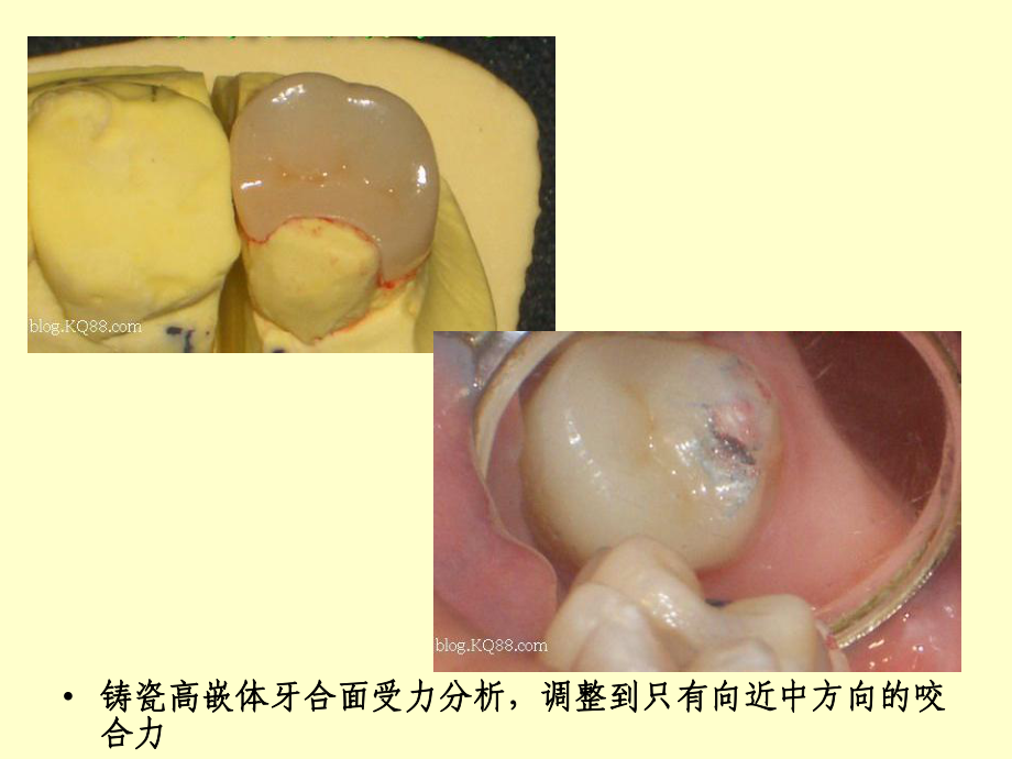 口腔修复病例讨论讲解课件.ppt_第3页