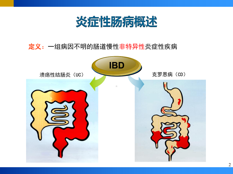 炎症性肠病(IBD)知识讲解课件.pptx_第2页