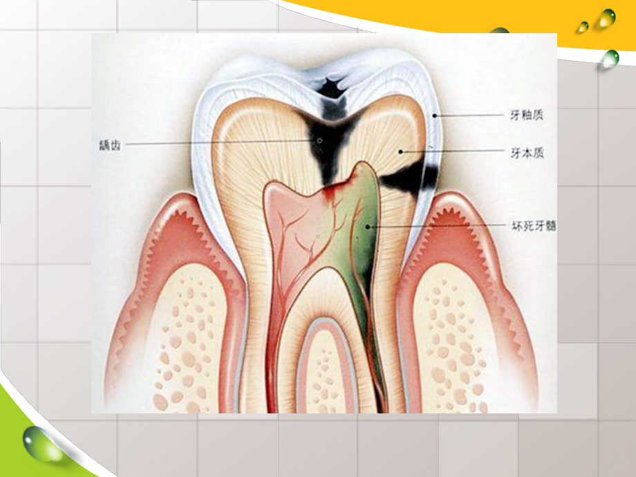 牙髓炎疾病梗概课件.pptx_第3页