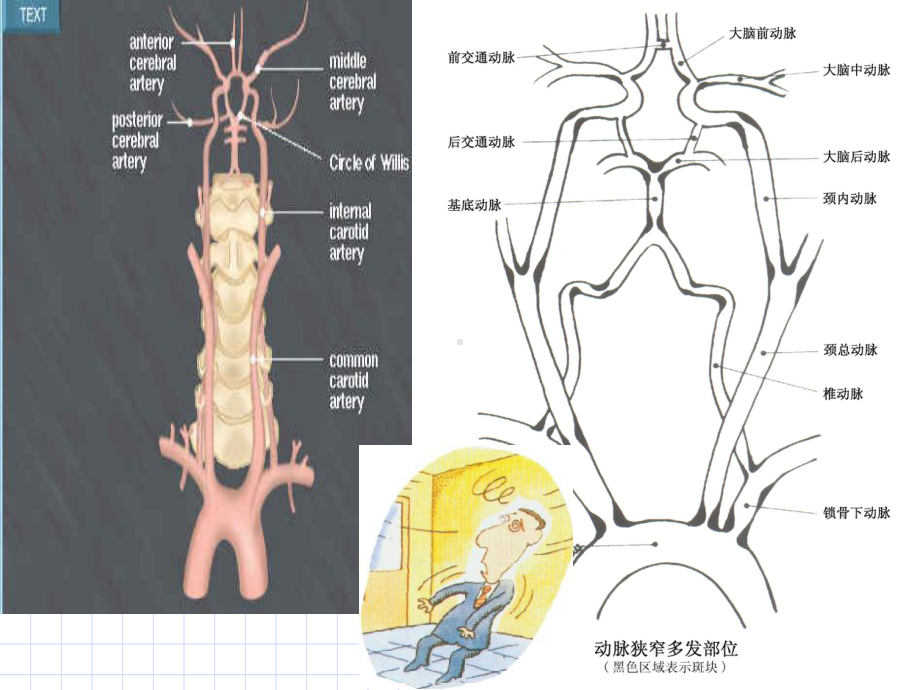 后循环缺血专家共识-资料课件.ppt_第3页