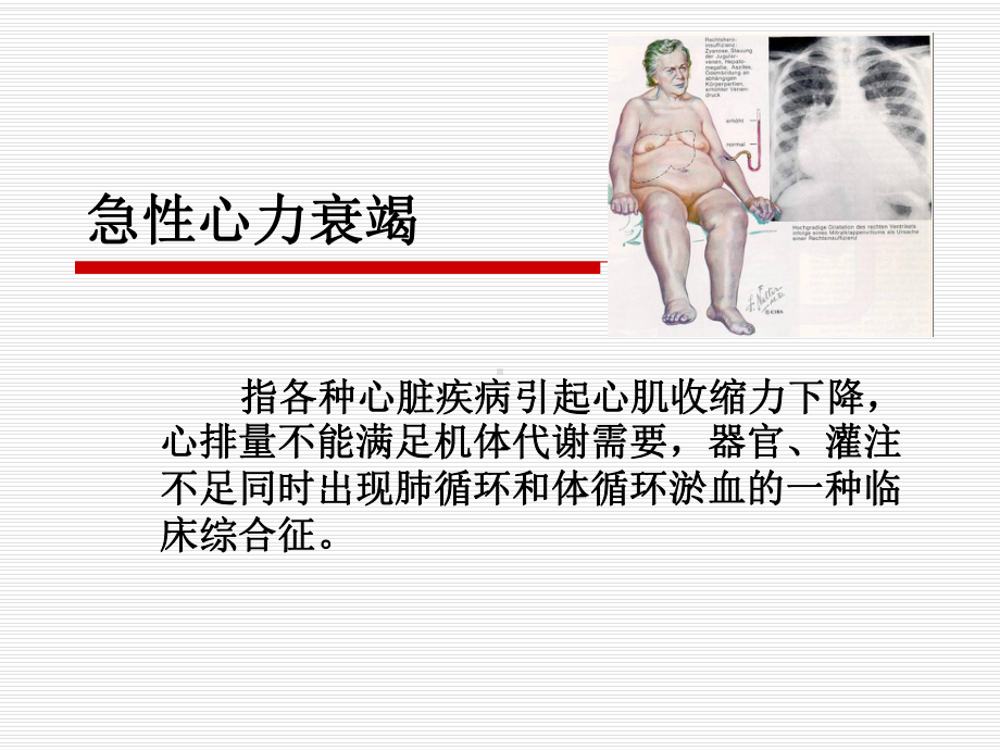 急性心力衰竭的急救护理-课件.ppt_第3页