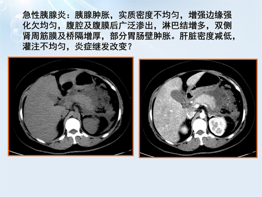 急性胰腺炎液体复苏说课讲解课件.ppt_第3页