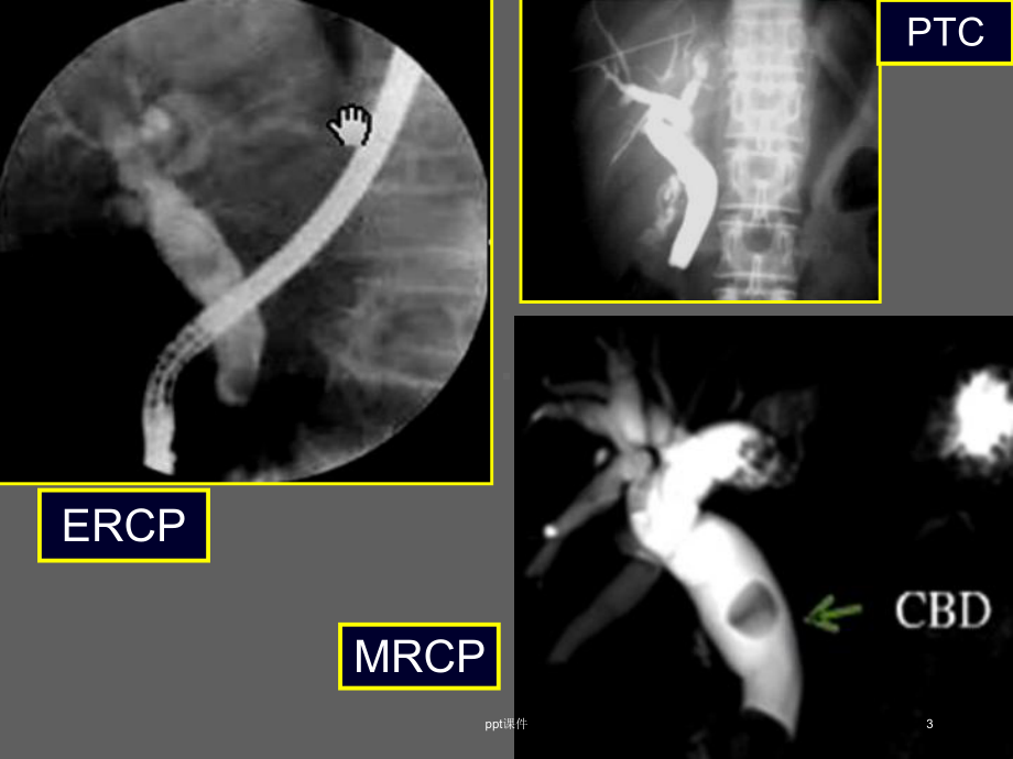 磁共振胰胆管造影(MRCP)的临床应用-课件.ppt_第3页