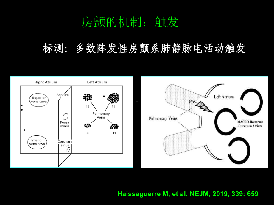 房颤的射频消融治疗-资料课件.ppt_第3页