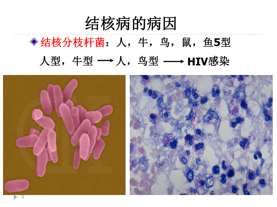 病理学-结核病-课件3.ppt_第3页