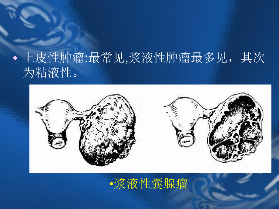 卵巢肿瘤课件-002.ppt_第3页