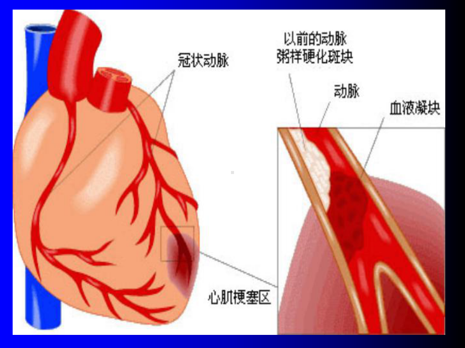 急性心肌梗死的急救护理课件-002.ppt_第2页