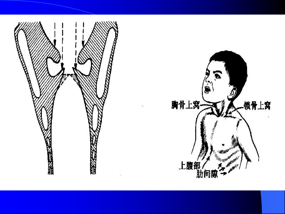 急性喉阻塞与气管切开术-Acute-laryngeal-obstru课件.ppt_第3页