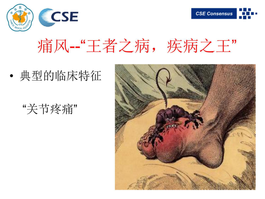 痛风讲课教程文件课件.ppt_第3页