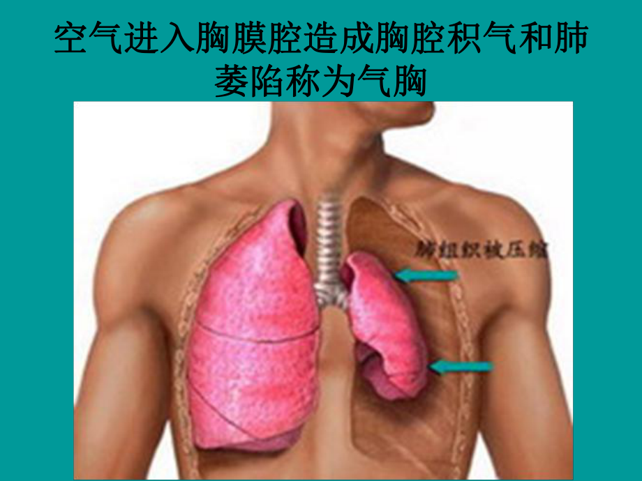 气胸的影像诊断解读课件.ppt_第2页