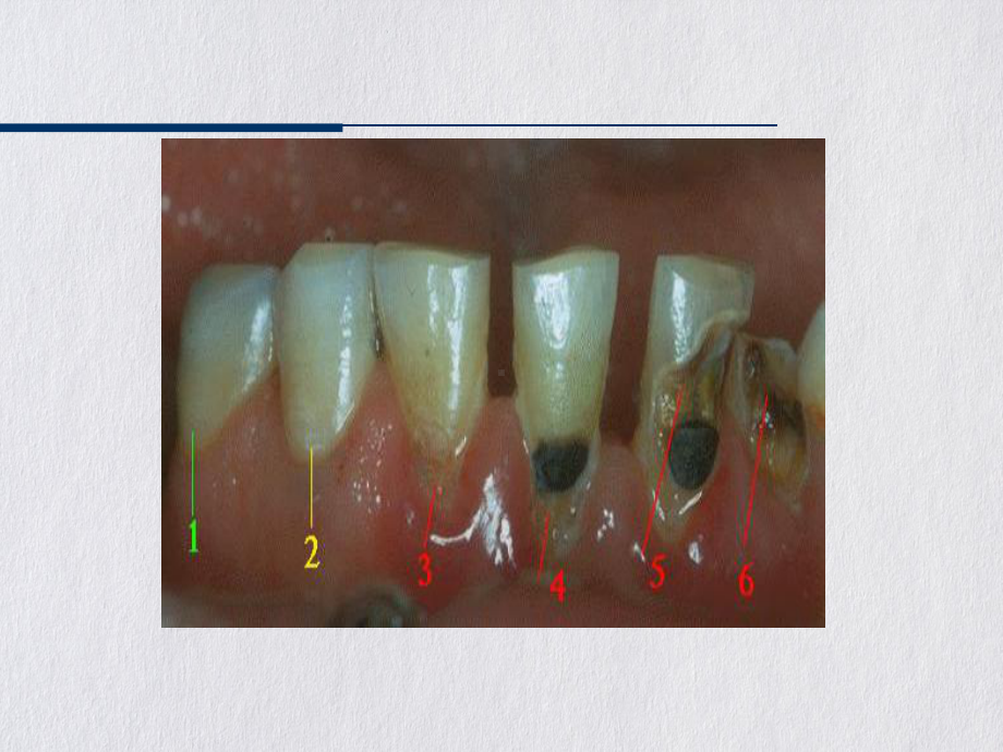 牙及牙周疾病的影像课件.pptx_第2页