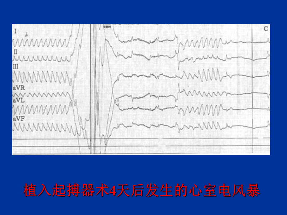 心电风暴学习HDYANGBZ课件.ppt_第3页