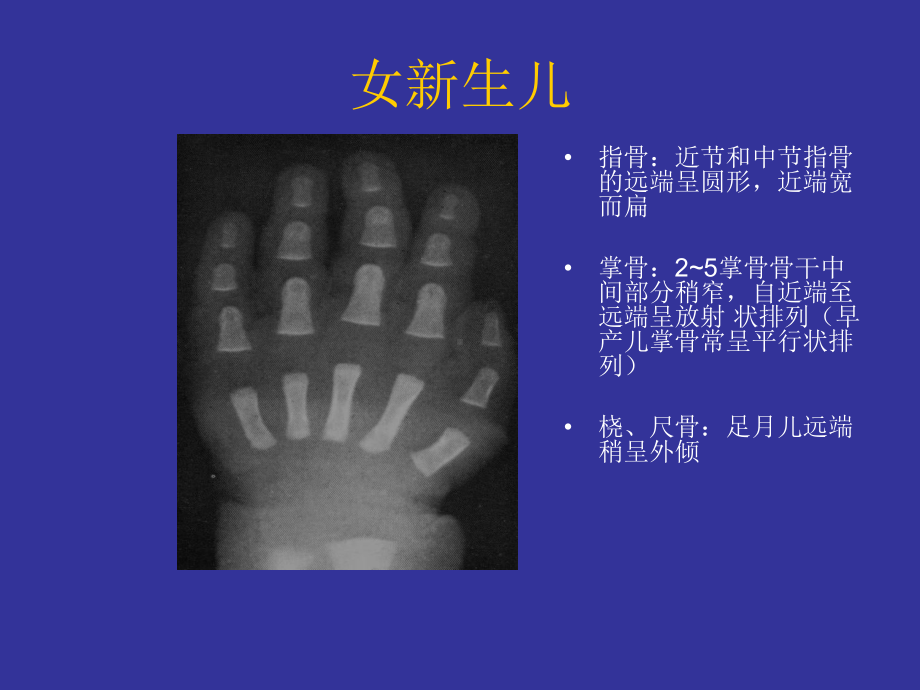 最新-女性骨龄片读片指南-课件.ppt_第3页