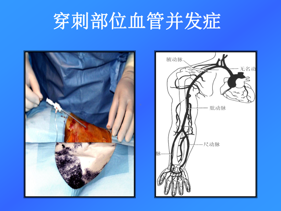 心脏介入治疗术后常见并发症预防与护理课件.ppt_第2页