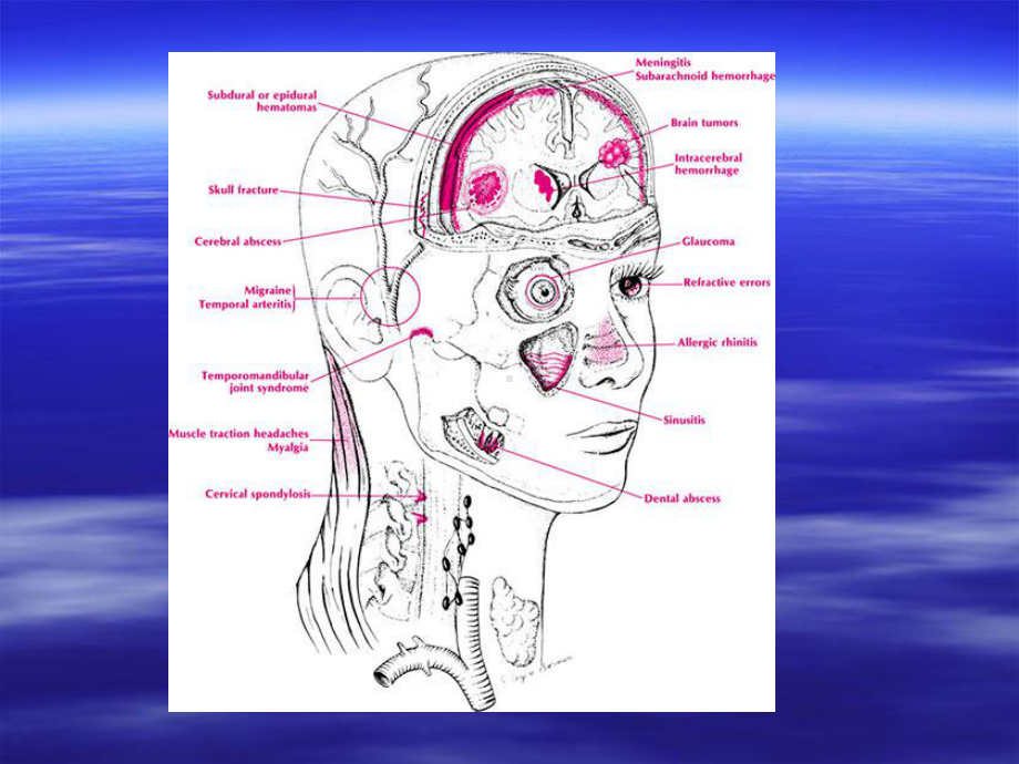 头痛的分类、诊断要点和常见讲义资料课件.ppt_第3页