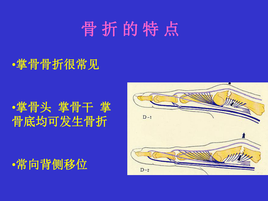 掌骨骨折内固定技术教学案例课件.ppt_第3页