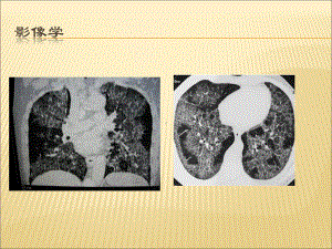 最新肺泡蛋白沉积症课件.pptx