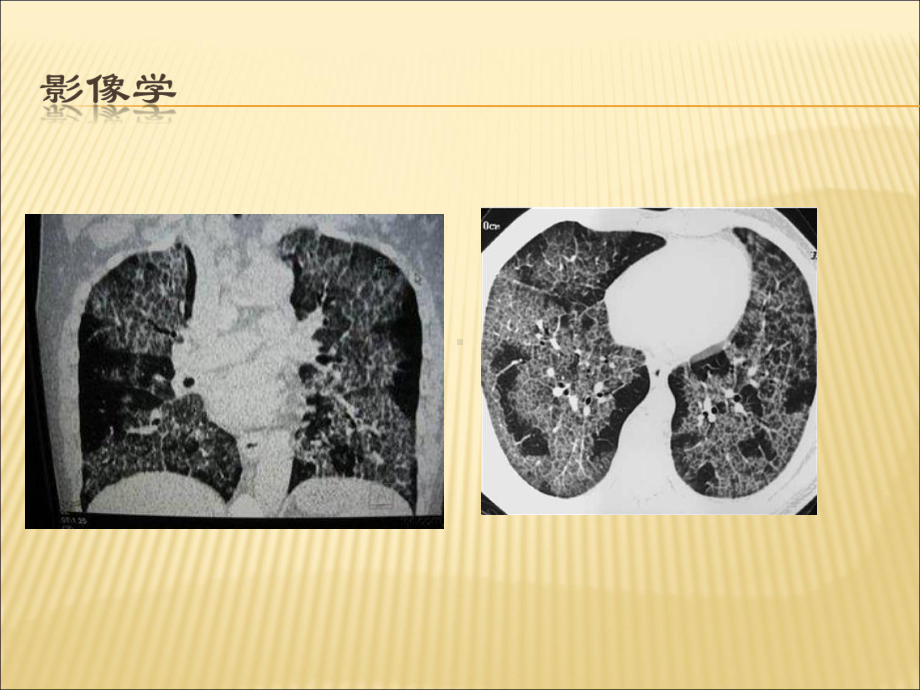 最新肺泡蛋白沉积症课件.pptx_第1页