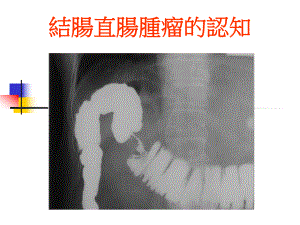 直肠癌的临床症状及表徵课件.ppt