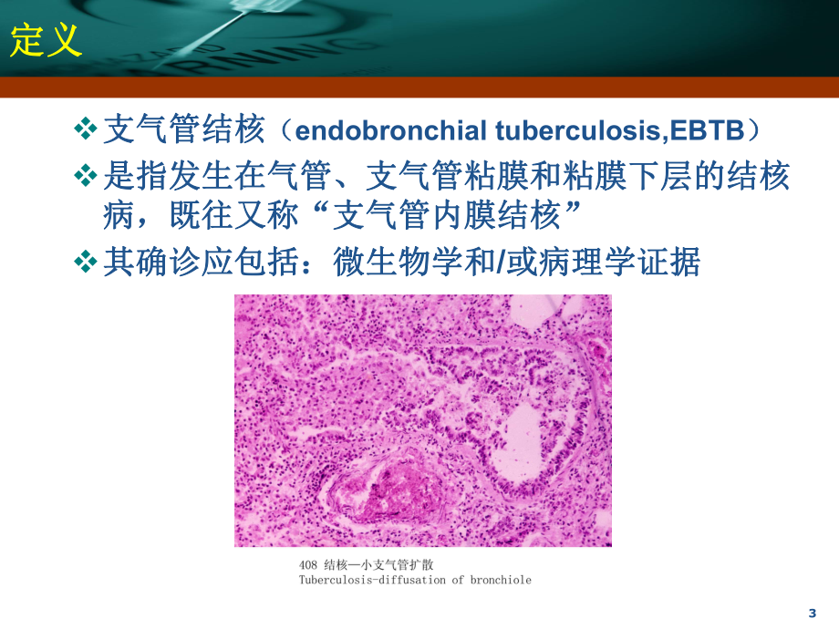 支气管结核诊疗及进展课件.ppt_第3页