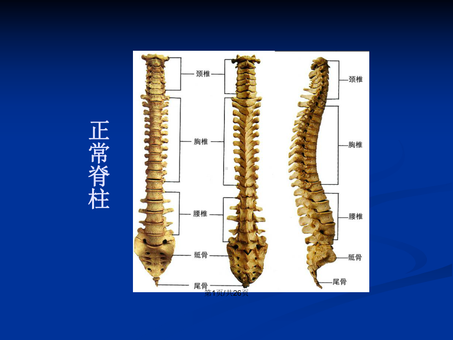 脊柱侧弯病人的护理教案课件.pptx_第2页