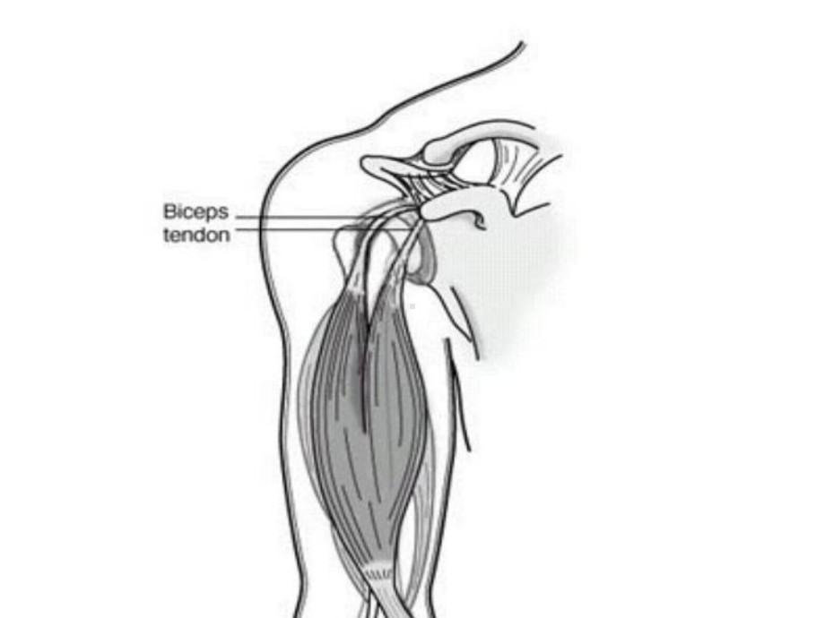 肱二头肌长头腱鞘炎课件.ppt_第3页