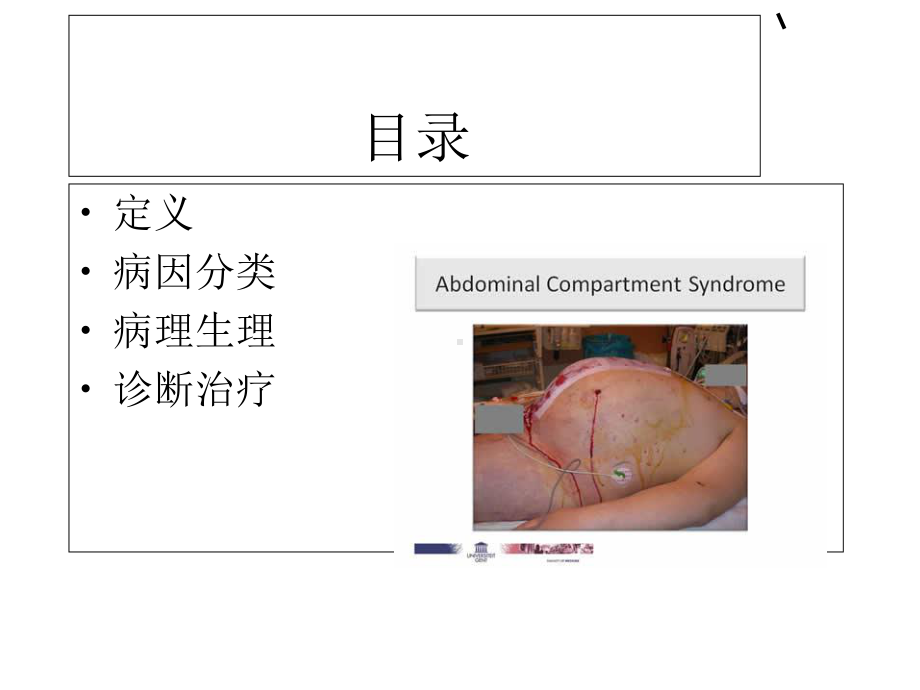 腹腔间隙综合征-课件.ppt_第2页