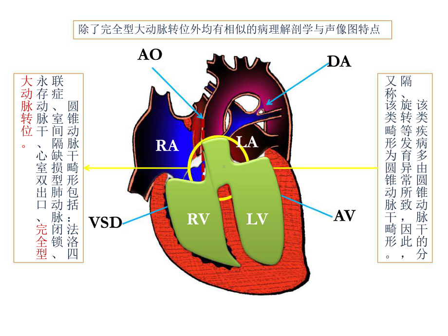 胎儿VSD+主动脉骑跨的超声诊断与鉴别课件.ppt_第2页