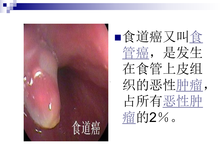 食管癌的治疗课件.ppt_第2页