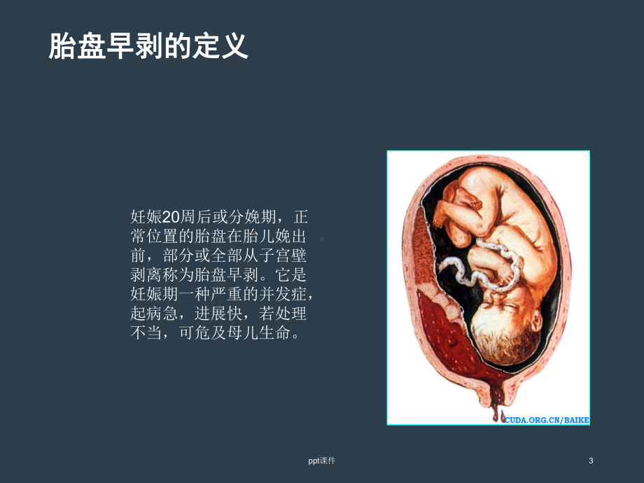 胎盘早剥的护理查房-课件.ppt_第3页