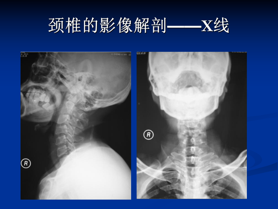 颈腰椎退行性疾病的影像学表现课件.ppt_第3页