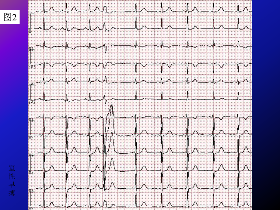 级专科医生培训心电图年度考核题答案课件.ppt_第2页