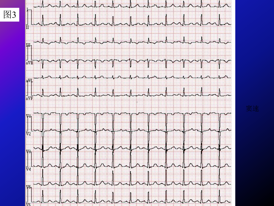 级专科医生培训心电图年度考核题答案课件.ppt_第3页