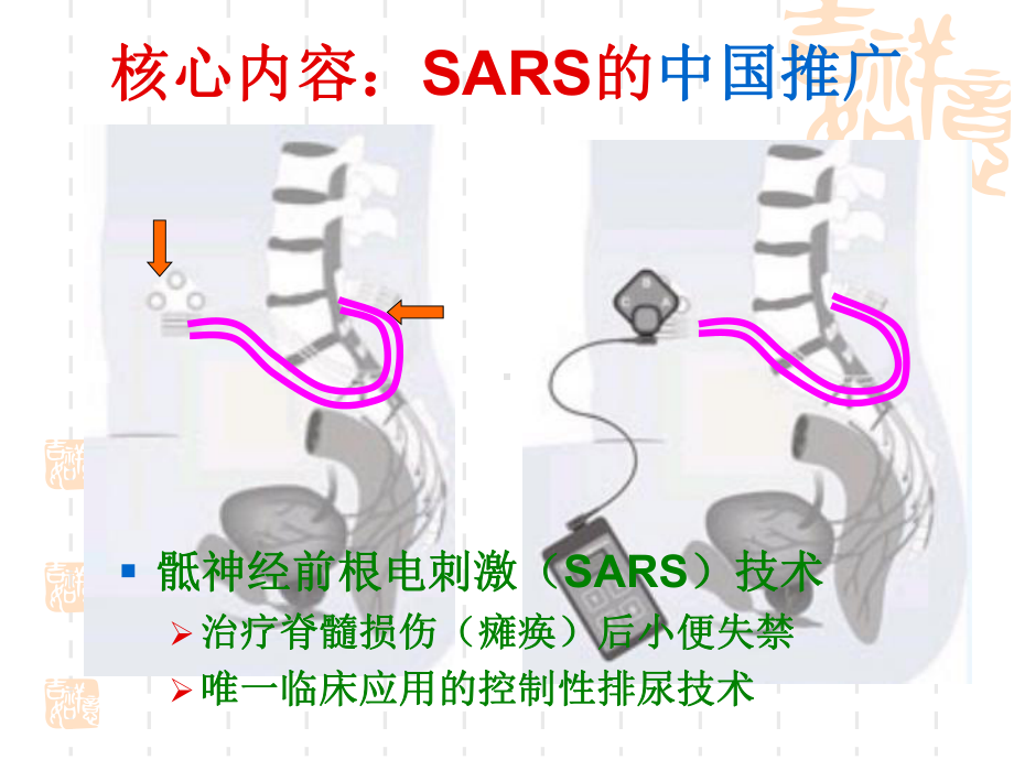 江苏卫生国际交流项目-瘫痪病人排尿功能的康复课件.ppt_第3页