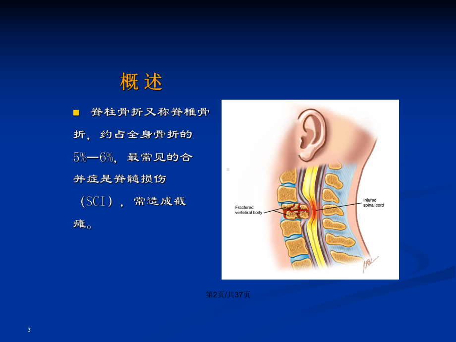 脊柱骨折3教案课件.pptx_第3页