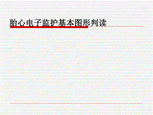 胎心电子监护基本图形判读医学课件-.ppt