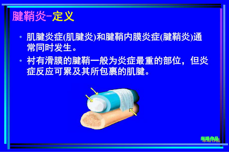 腱鞘炎析课件-.ppt_第2页