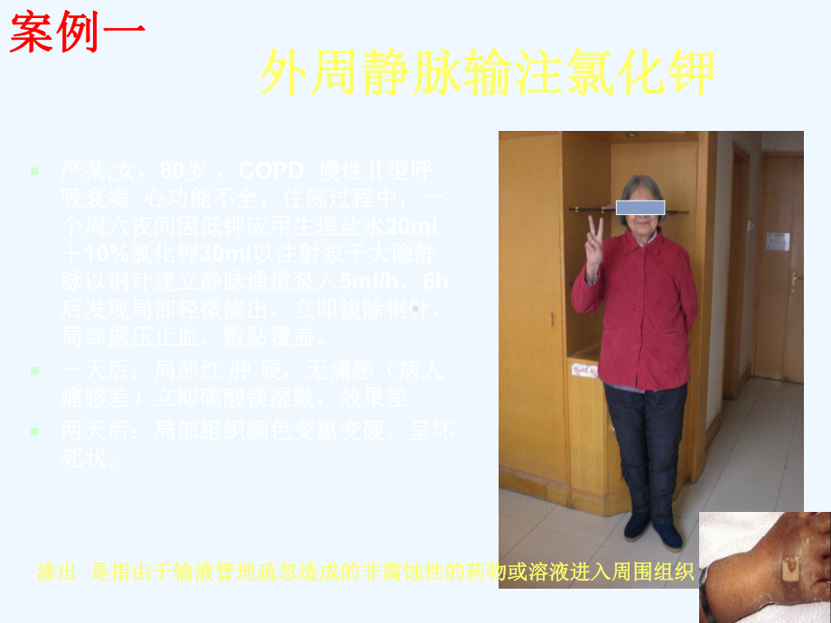 静脉血管评估与分级课件.ppt_第3页