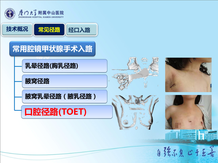 经口入路腔镜状腺切除术课件-课件.ppt_第2页