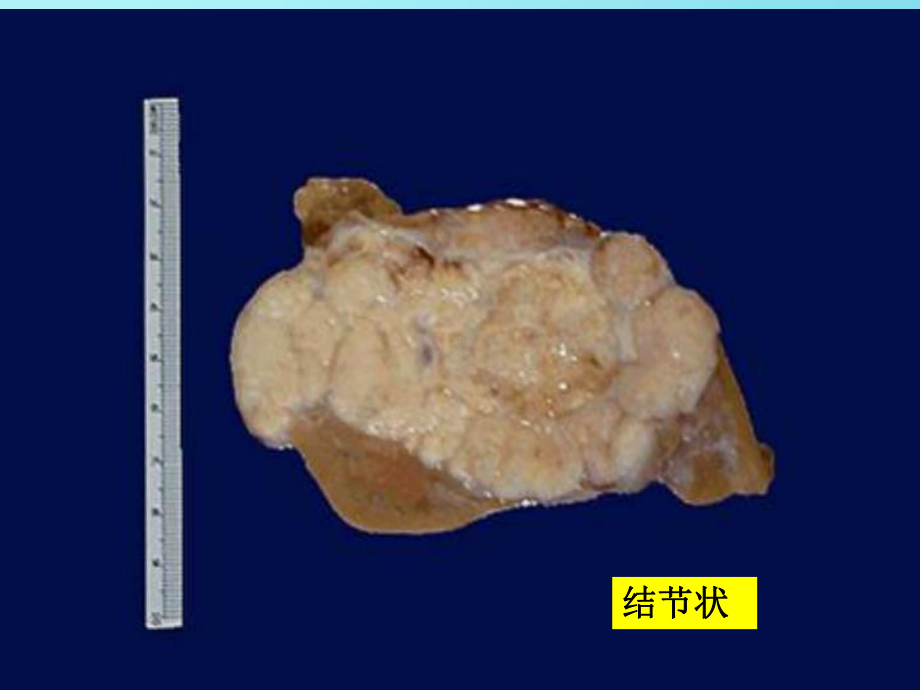 肿瘤学概论--肿瘤病理学课件.ppt_第2页