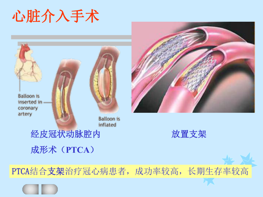 缺血再灌注损伤分析课件.ppt_第2页