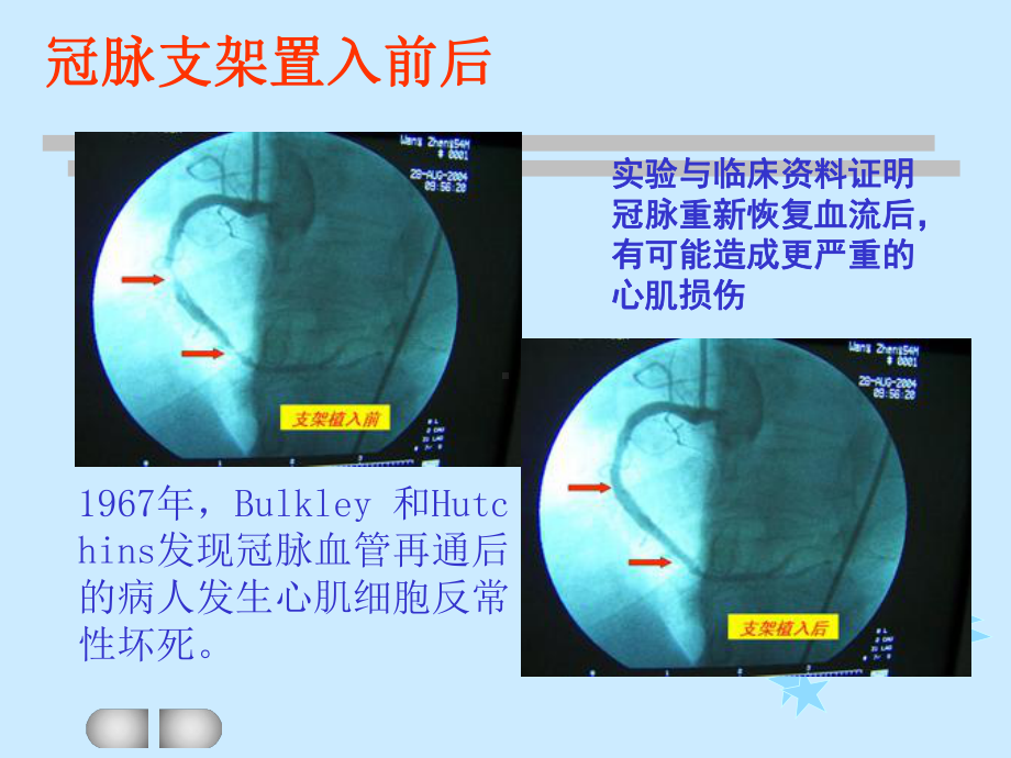 缺血再灌注损伤分析课件.ppt_第3页