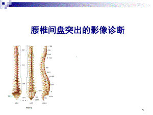 腰椎间盘突出的影像诊断1课件.ppt