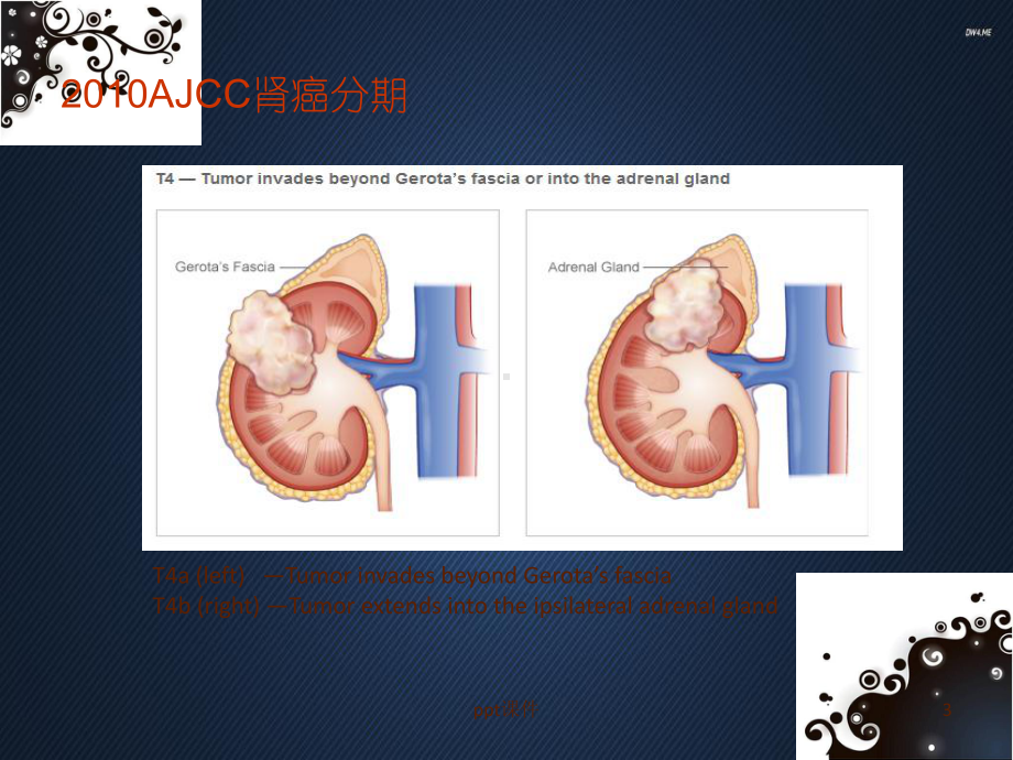 转移性肾癌靶向治疗现状与进展-课件.ppt_第3页