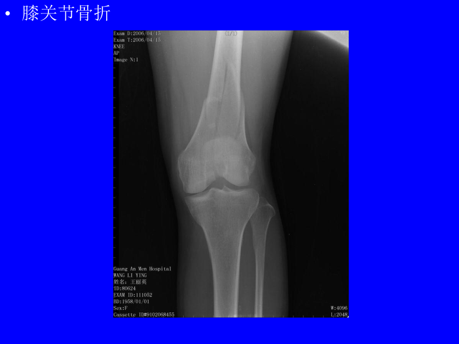 骨骼系统常见病X线表现讲解材料课件.ppt_第3页